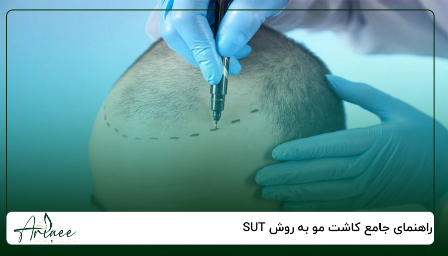 راهنمای جامع کاشت مو به روش SUT