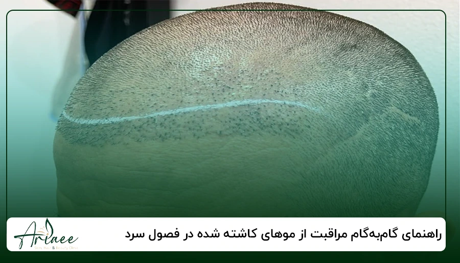 راهنمای گام_به_گام مراقبت از موهای کاشته شده در فصول سرد