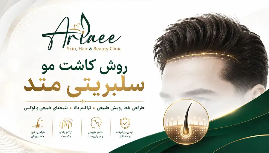 روش کاشت مو سلبریتی متد