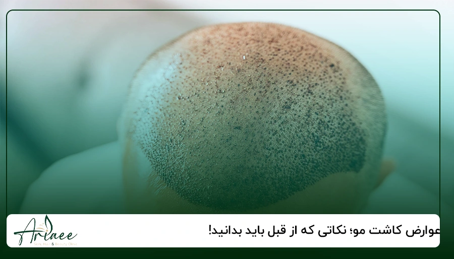 عوارض کاشت مو؛ نکاتی که از قبل باید بدانید!