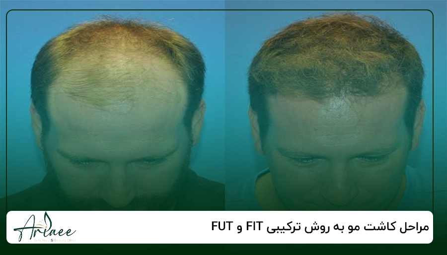 مراحل کاشت مو به روش ترکیبی FIT و FUT