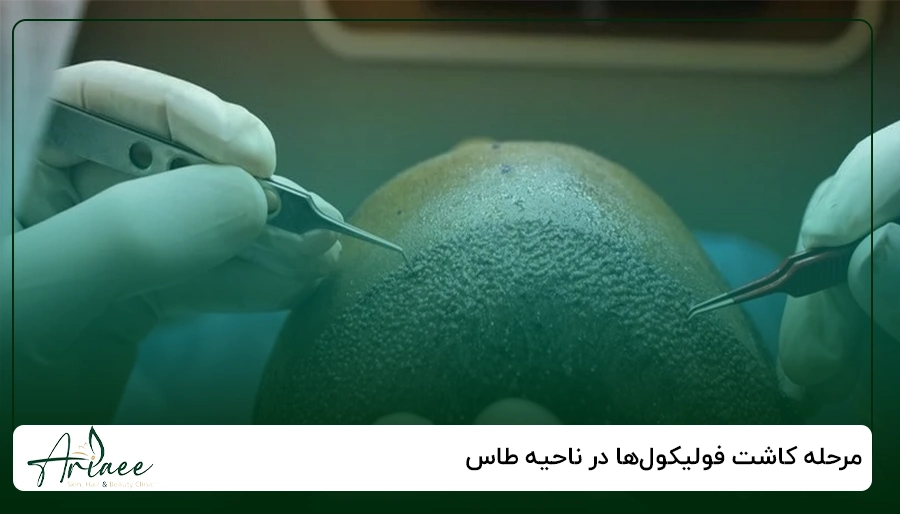 مرحله کاشت فولیکول_ها در ناحیه طاس