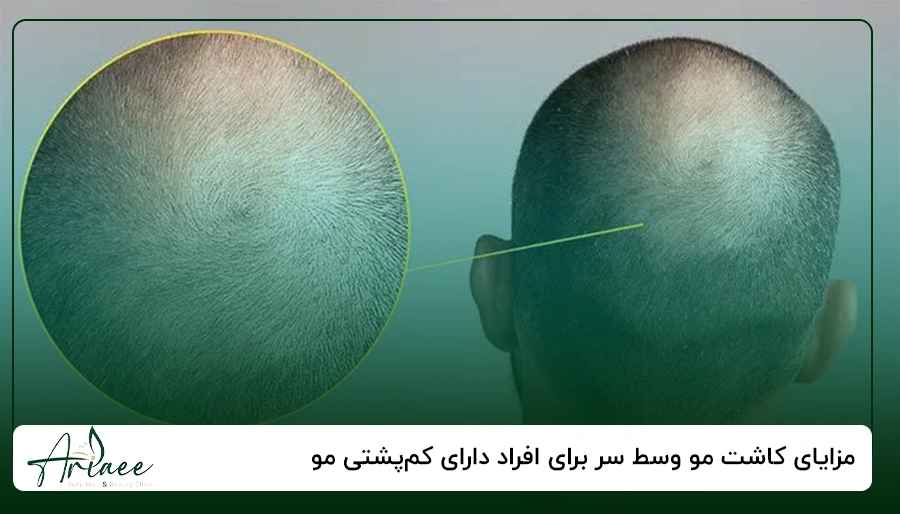 مزایای کاشت مو وسط سر برای افراد دارای کم_پشتی مو