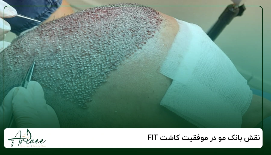 نقش بانک مو در موفقیت کاشت FIT
