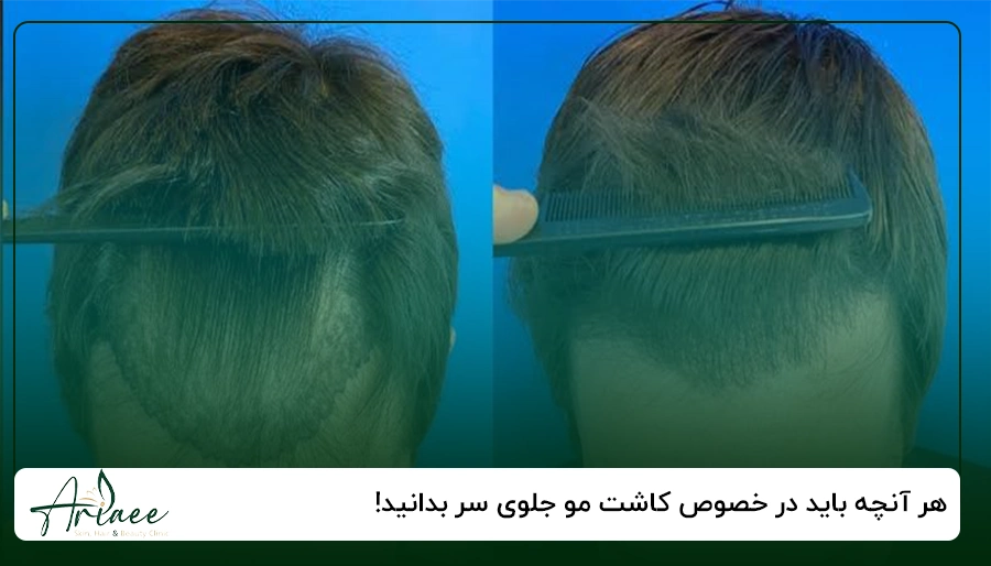 هر آنچه باید در خصوص کاشت مو جلوی سر بدانید!