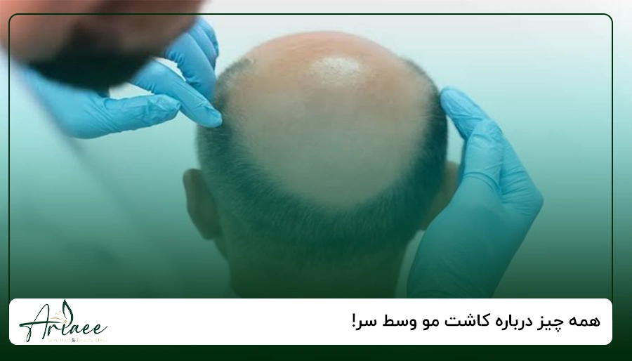 همه چیز درباره کاشت مو وسط سر!