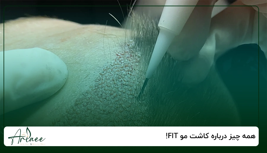 همه چیز درباره کاشت مو FIT!