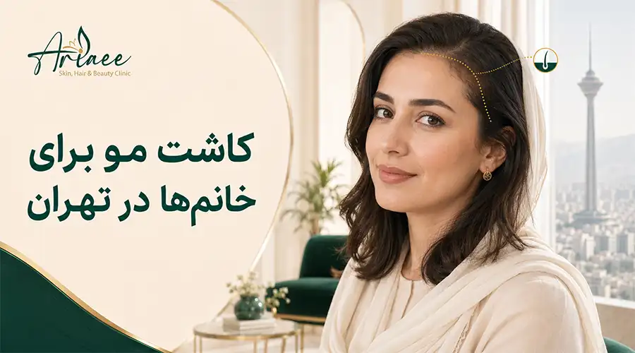 کاشت مو برای خانم‌ها در تهران