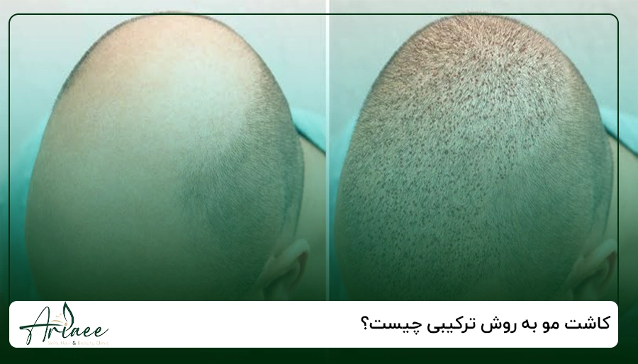 کاشت مو به روش ترکیبی چیست؟