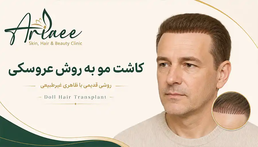 کاشت مو به روش عروسکی
