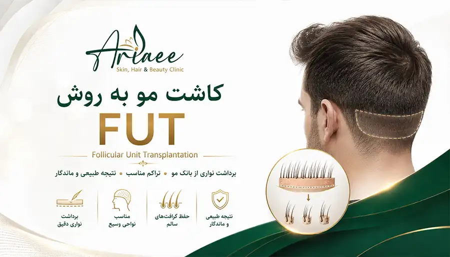 کاشت مو به روش FUT (Follicular Unit Transplantation)