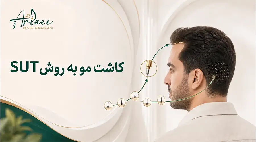 کاشت مو به روش SUT