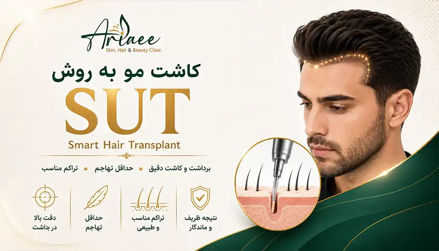 کاشت مو به روش SUT (Smart Hair Transplant)