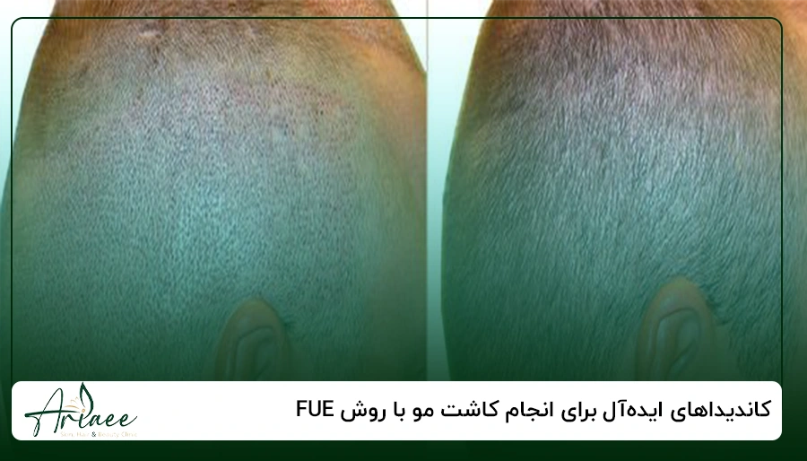 کاندیداهای ایده_آل برای انجام کاشت مو با روش FUE