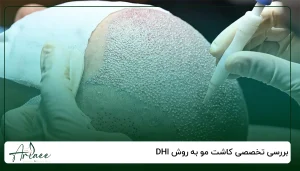 بررسی تخصصی کاشت مو به روش DHI