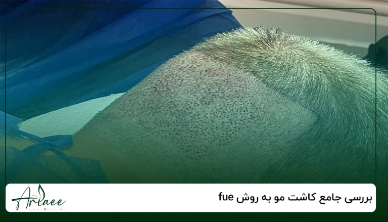 بررسی جامع کاشت مو به روش fue
