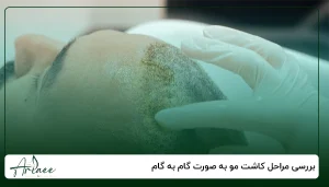بررسی مراحل کاشت مو به صورت گام به گام