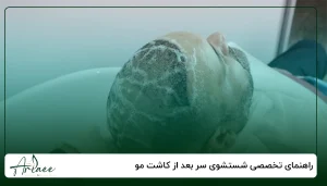 راهنمای تخصصی شستشوی سر بعد از کاشت مو