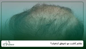 علائم کاشت مو ناموفق کدام_اند؟
