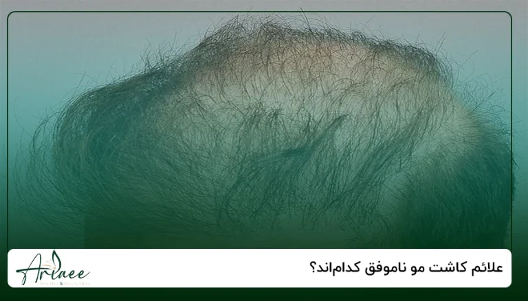 علائم کاشت مو ناموفق کدام_اند؟