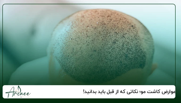 عوارض کاشت مو؛ نکاتی که از قبل باید بدانید!