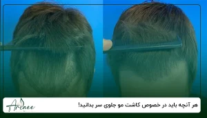 هر آنچه باید در خصوص کاشت مو جلوی سر بدانید!