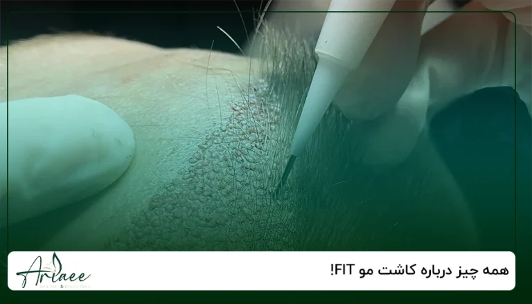 همه چیز درباره کاشت مو FIT!
