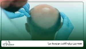همه چیز درباره کاشت مو وسط سر!