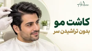 کاشت مو بدون تراشیدن سر