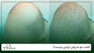 کاشت مو به روش ترکیبی چیست؟