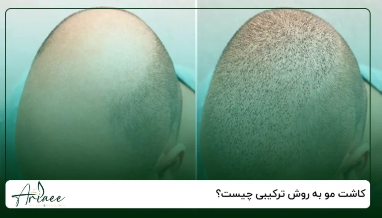 کاشت مو به روش ترکیبی چیست؟