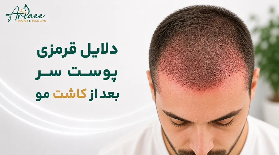 دلایل قرمزی پوست سر بعد از کاشت مو