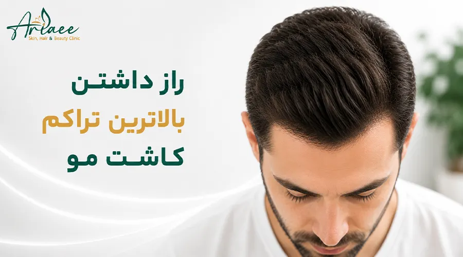 راز داشتن بالاترین تراکم کاشت مو