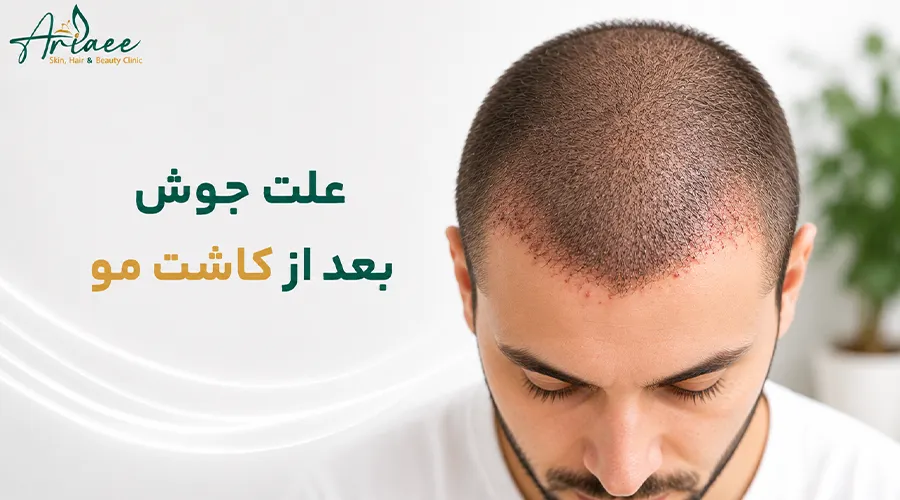 علت جوش بعد از کاشت مو