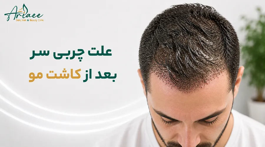 علت چربی سر بعد از کاشت مو