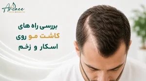 بررسی راه های کاشت مو روی اسکار و زخم