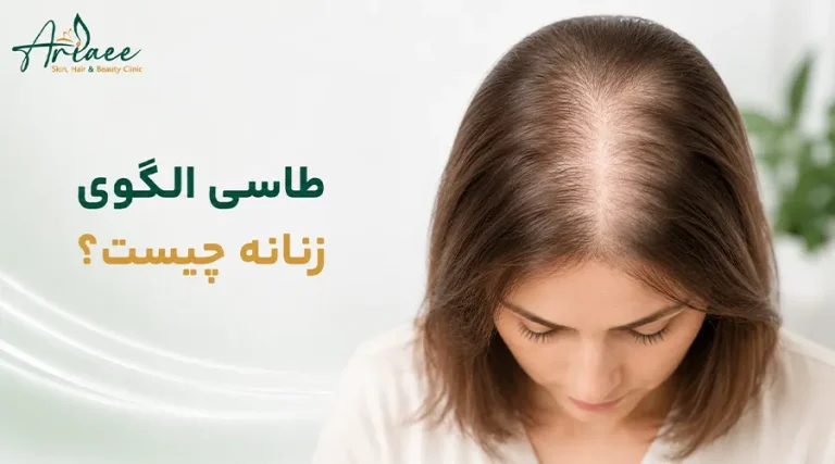 طاسی الگوی زنانه چیست؟