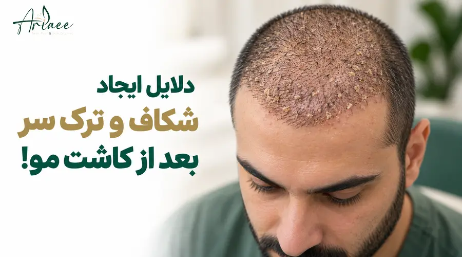 دلایل ایجاد شکاف و ترک سر بعد از کاشت مو!
