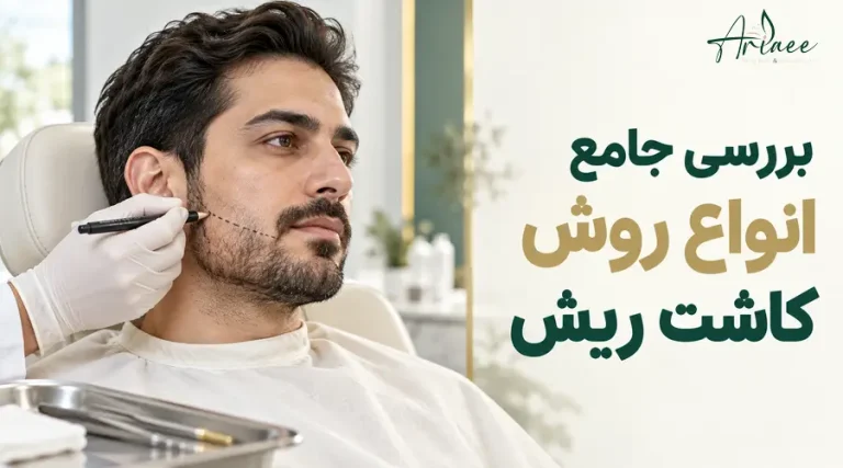 بررسی جامع انواع روش کاشت ریش
