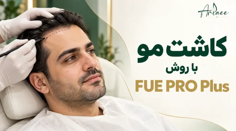 کاشت مو با روش FUE PRO Plus